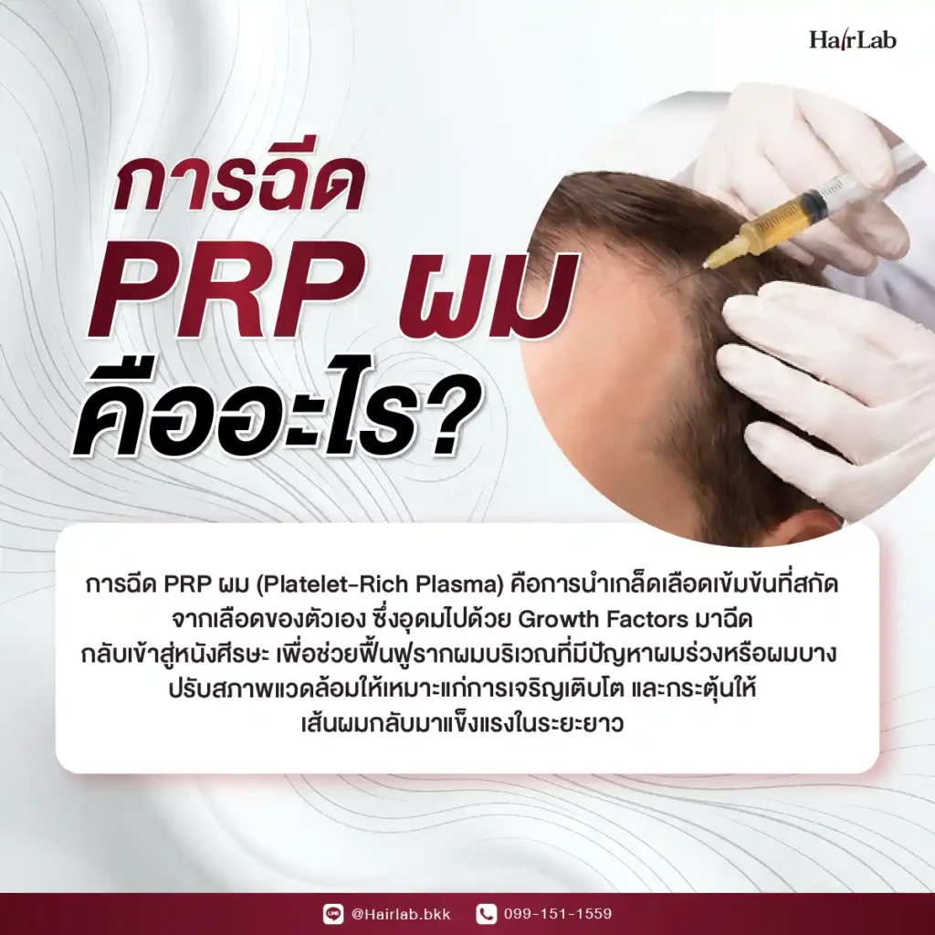 ฉีด PRP ผม คืออะไร