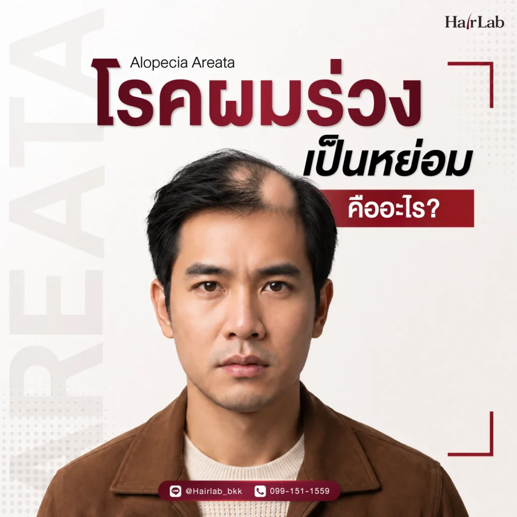 โรคผมร่วงเป็นหย่อม คืออะไร