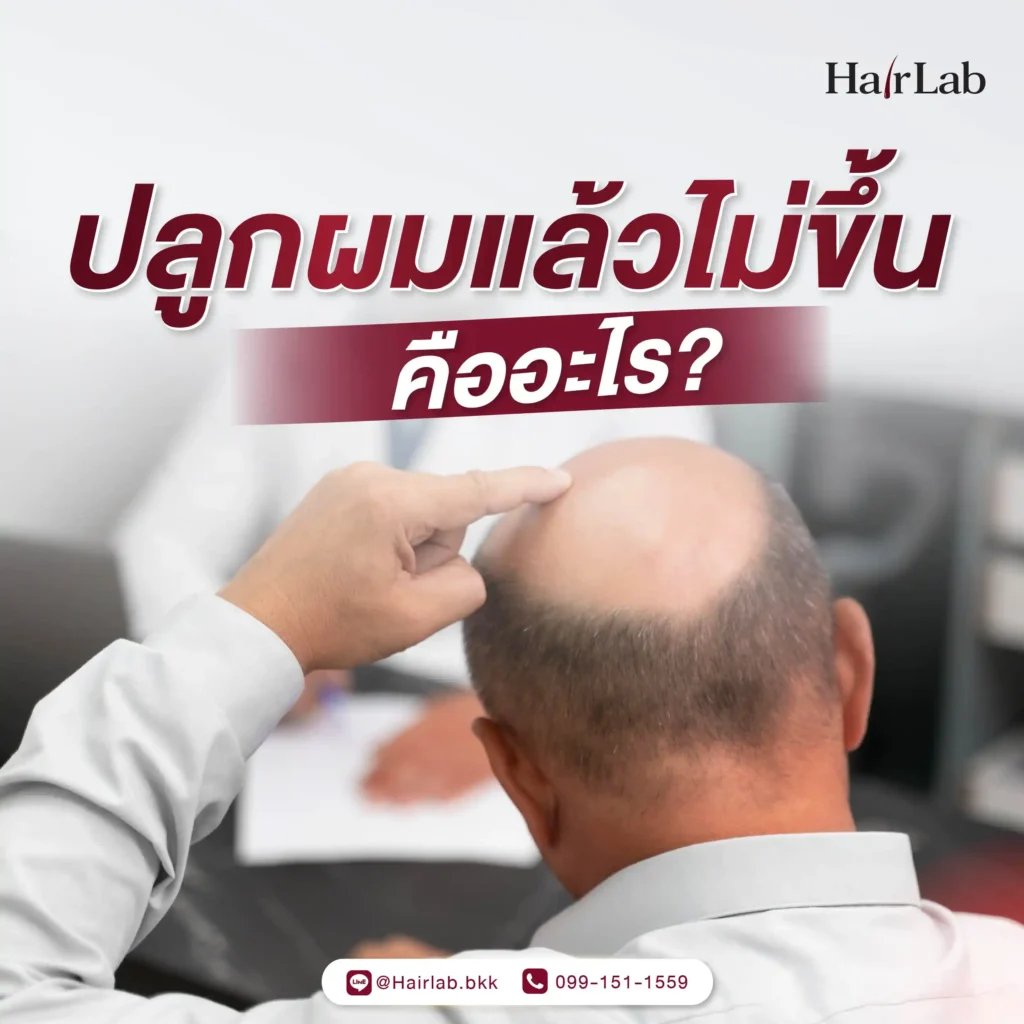 ปลูกผมแล้วไม่ขึ้น คืออะไร