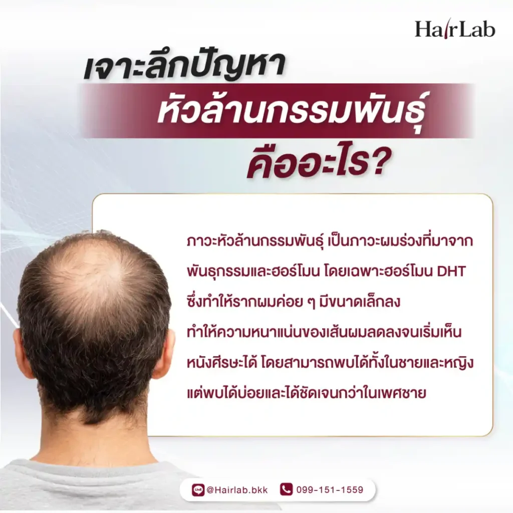หัวล้านกรรมพันธุ์ คืออะไร