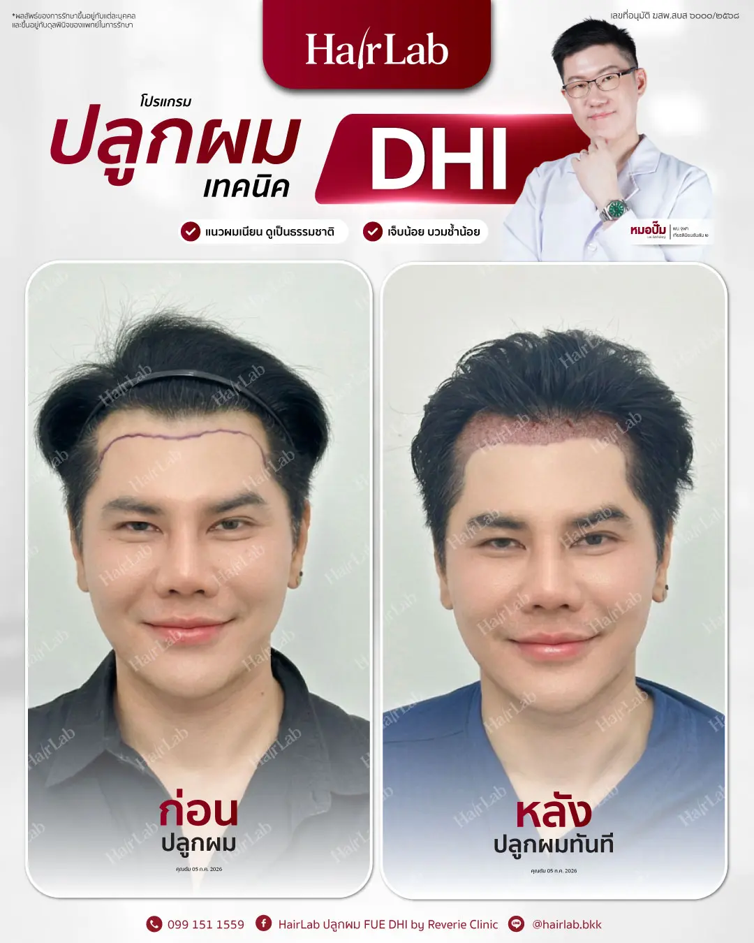 ก่อน-หลังปลูกผมเทคนิค DHI -22