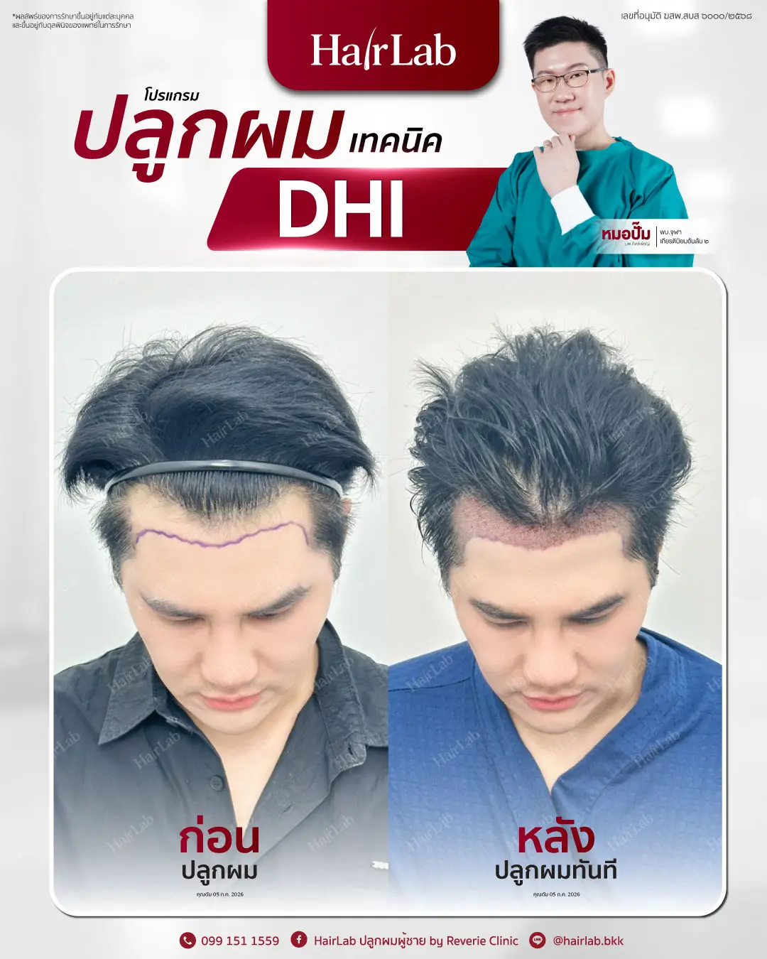 ก่อน-หลังปลูกผมเทคนิค DHI -23