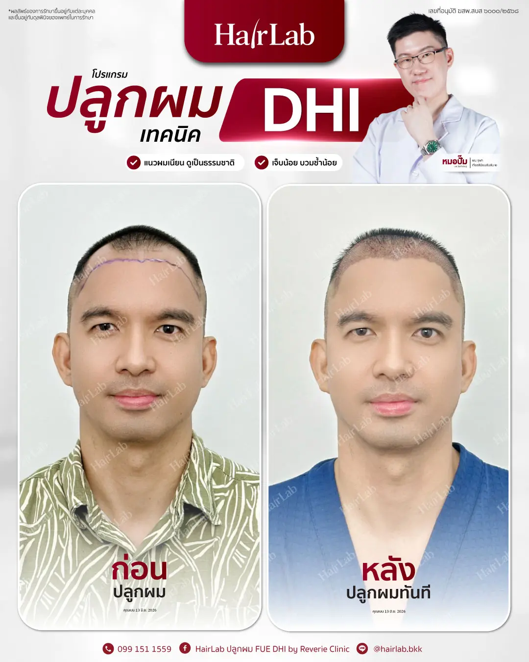 ก่อน-หลังปลูกผมเทคนิค DHI -24