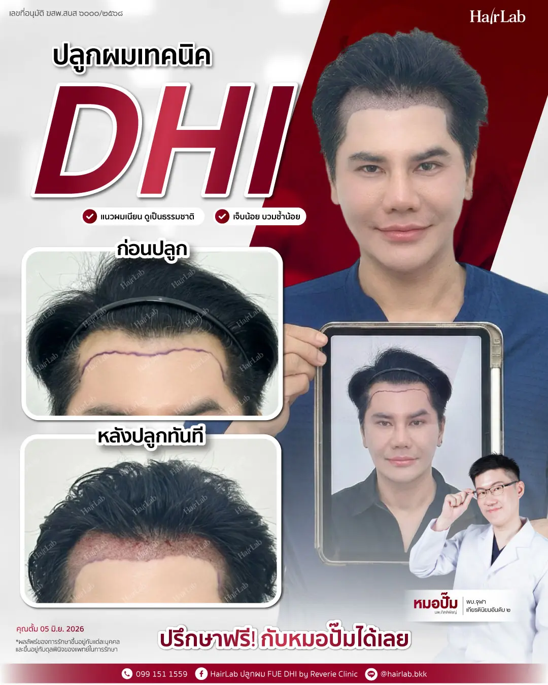 ก่อน-หลังปลูกผมเทคนิค DHI -25