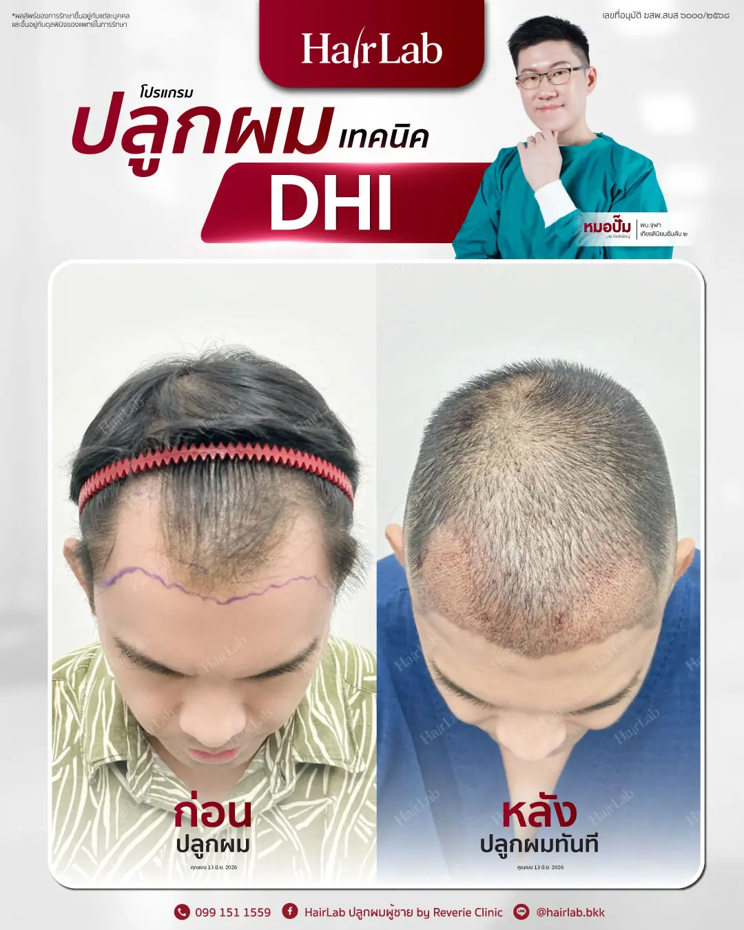 ก่อน-หลังปลูกผมเทคนิค DHI -27