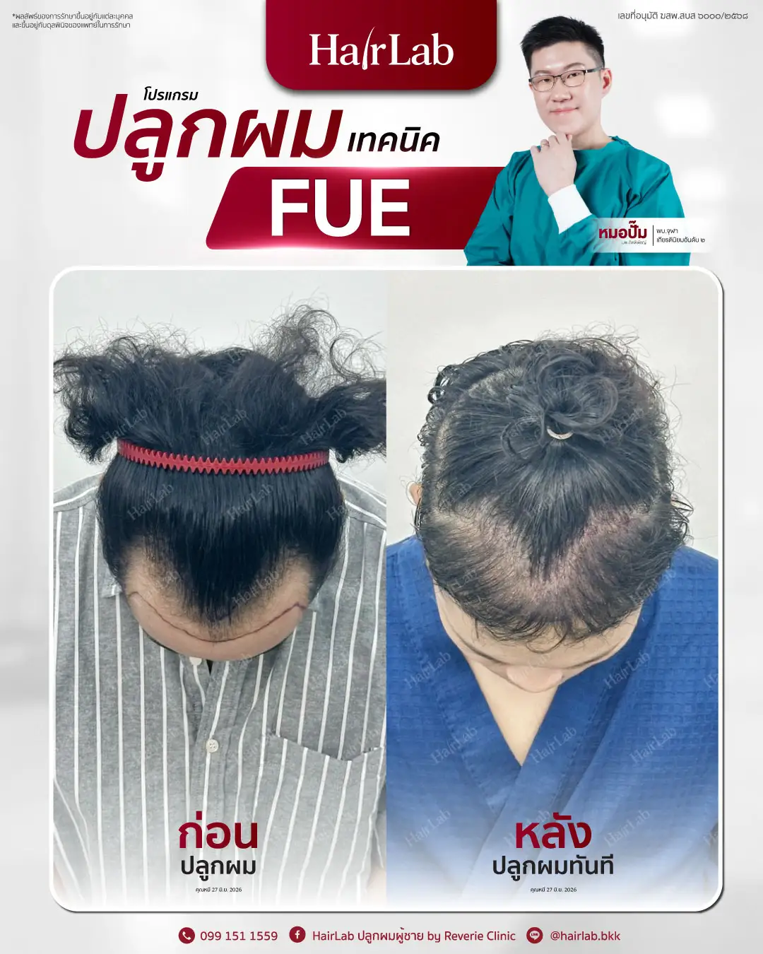ก่อน-หลังปลูกผมเทคนิค FUE-10