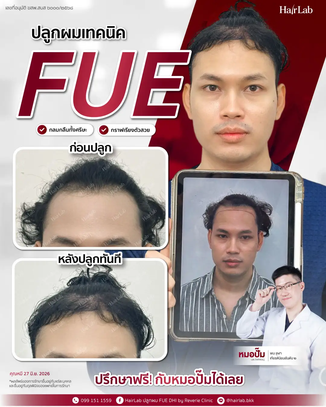 ก่อน-หลังปลูกผมเทคนิค FUE-05