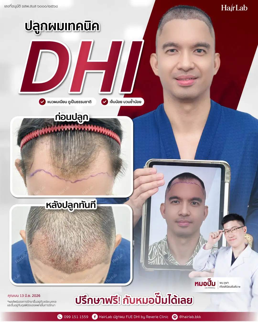 ก่อน-หลังปลูกผมเทคนิค FUE-07