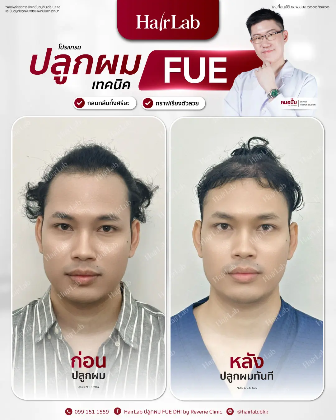 ก่อน-หลังปลูกผมเทคนิค FUE-09