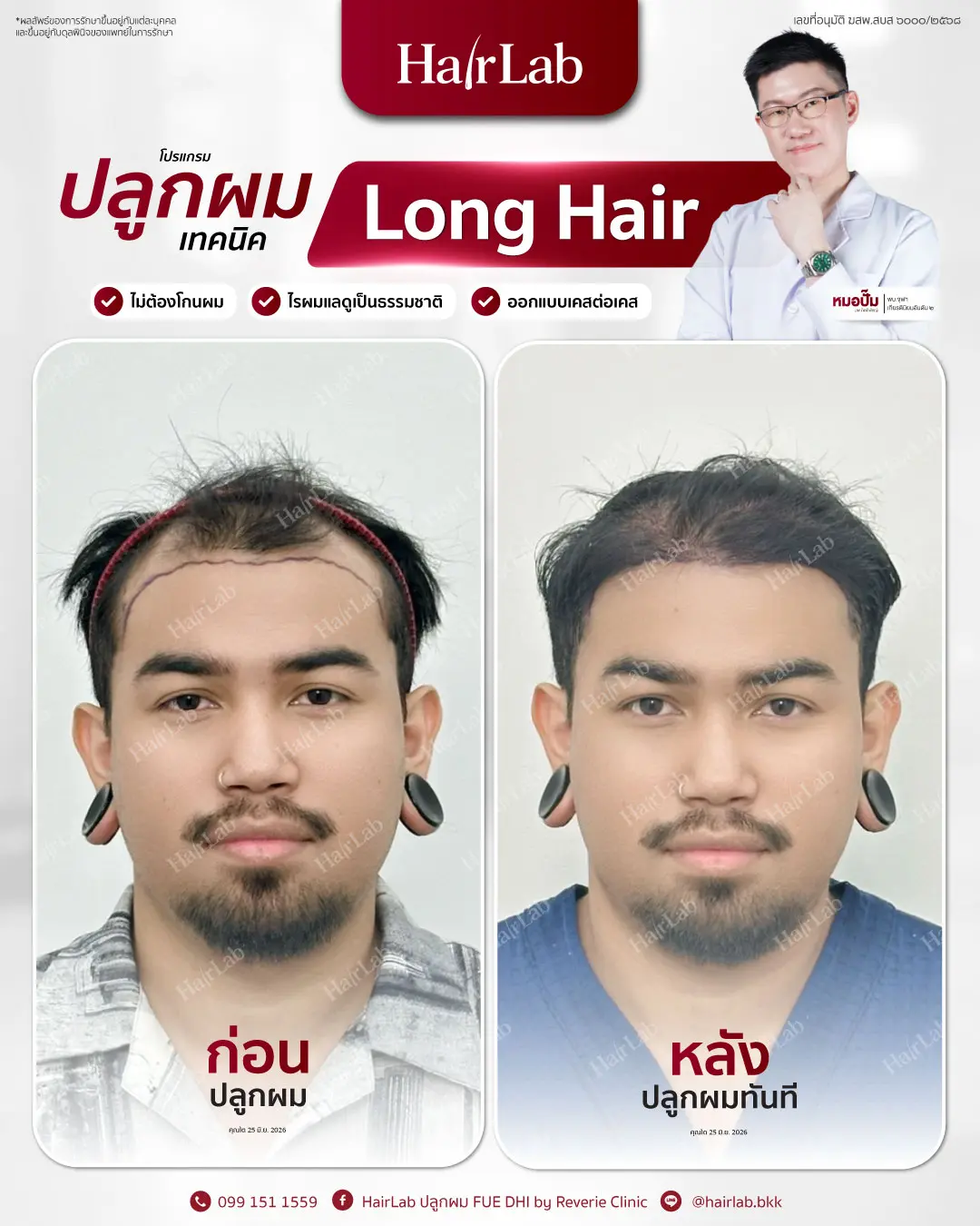 ก่อน-หลังปลูกผมเทคนิค Long Hair-09