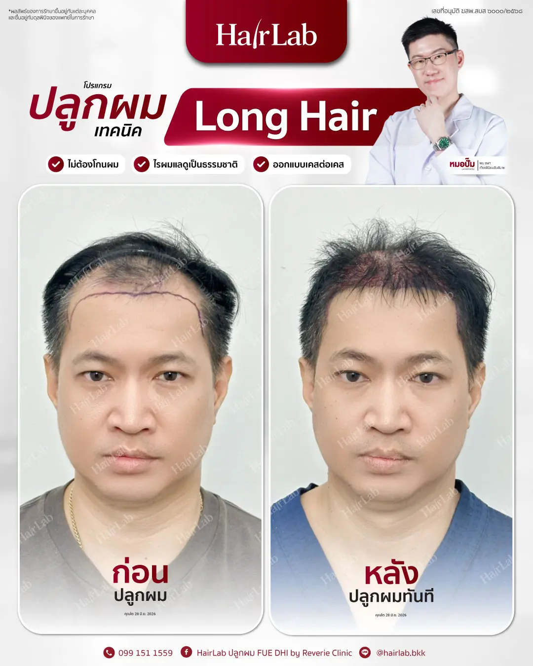 ก่อน-หลังปลูกผมเทคนิค Long Hair-10