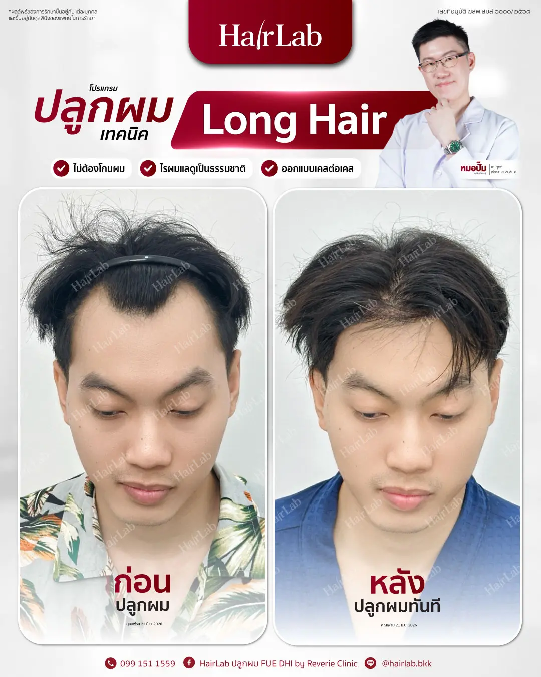 ก่อน-หลังปลูกผมเทคนิค Long Hair-11