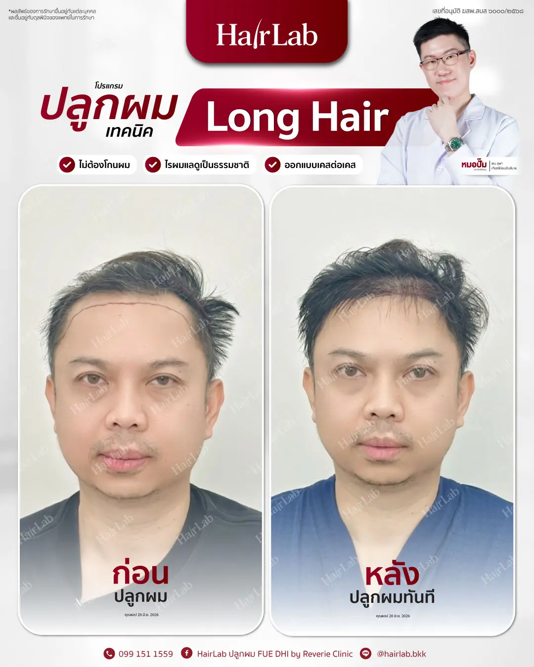 ก่อน-หลังปลูกผมเทคนิค Long Hair-12