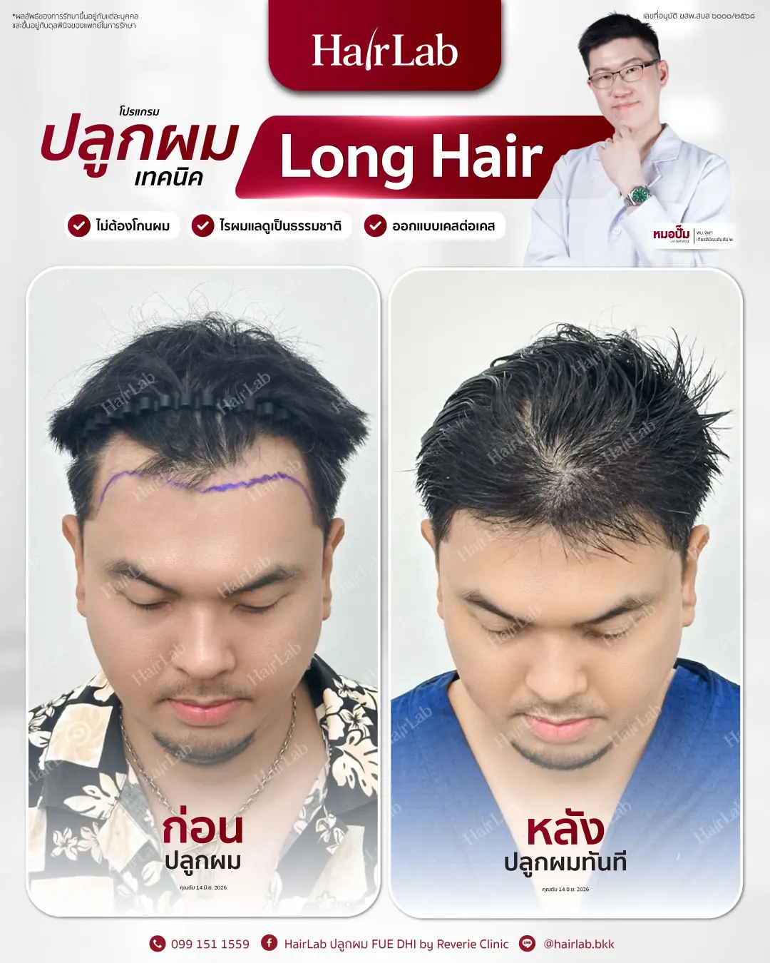 ก่อน-หลังปลูกผมเทคนิค Long Hair-13