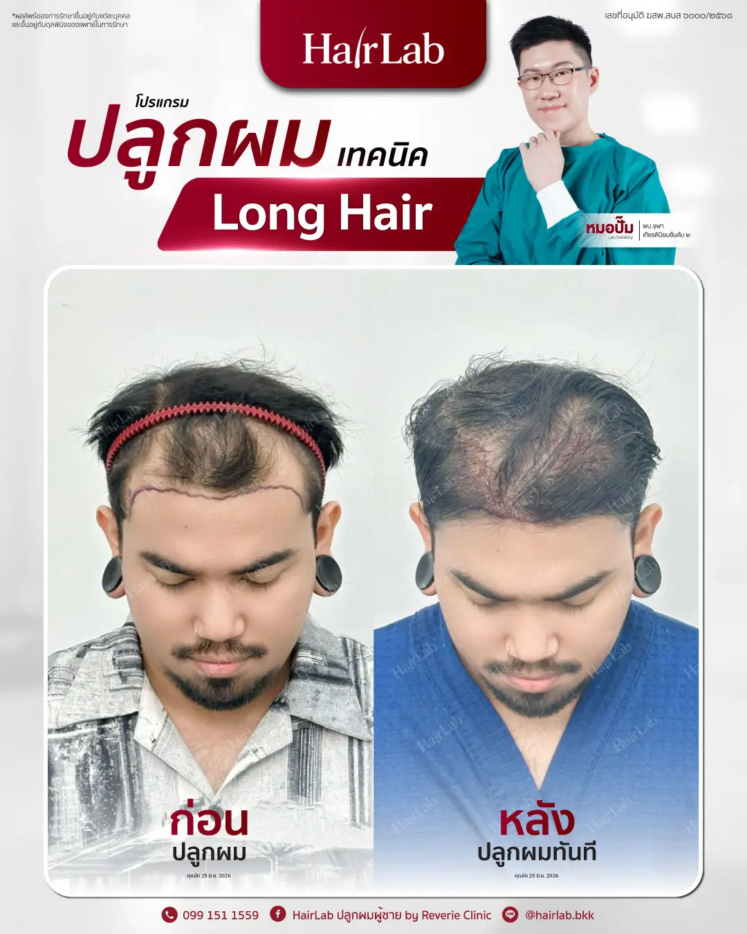 ก่อน-หลังปลูกผมเทคนิค Long Hair-14