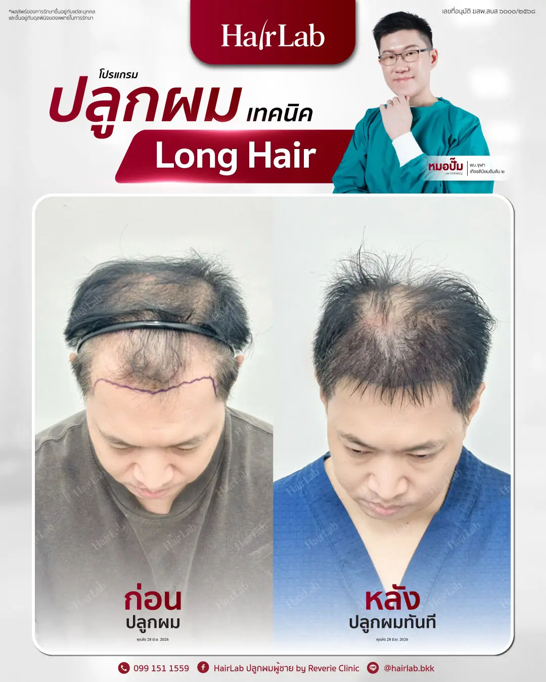 ก่อน-หลังปลูกผมเทคนิค Long Hair-15