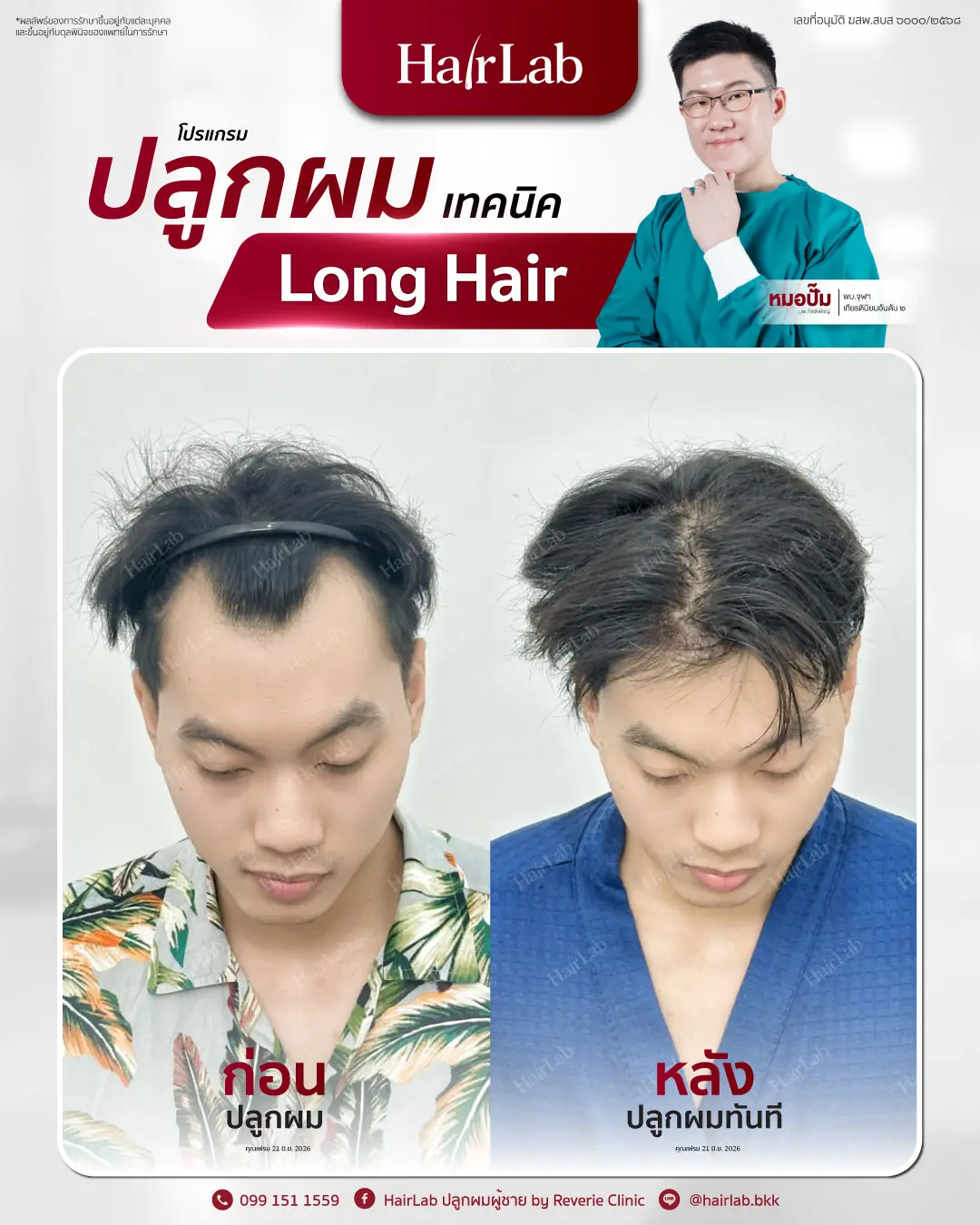 ก่อน-หลังปลูกผมเทคนิค Long Hair-16