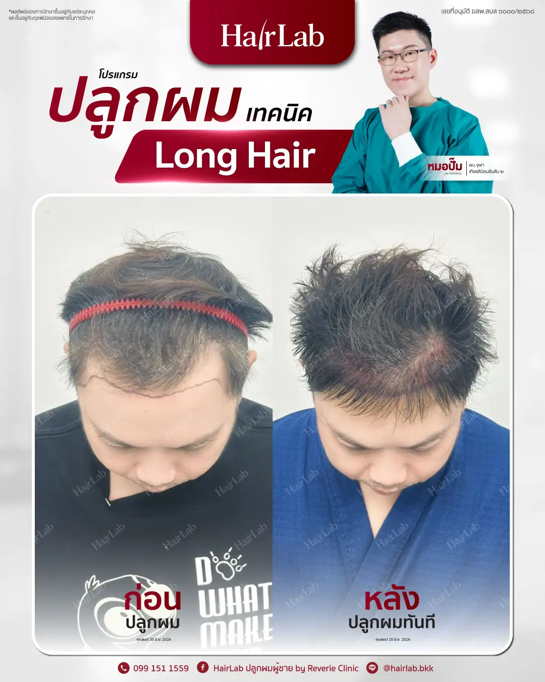ก่อน-หลังปลูกผมเทคนิค Long Hair-17