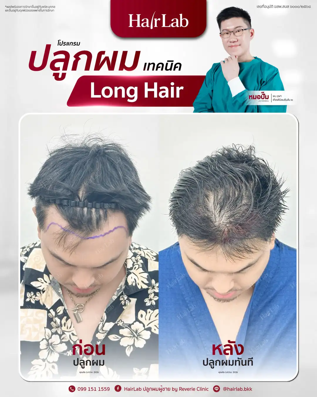 ก่อน-หลังปลูกผมเทคนิค Long Hair-18