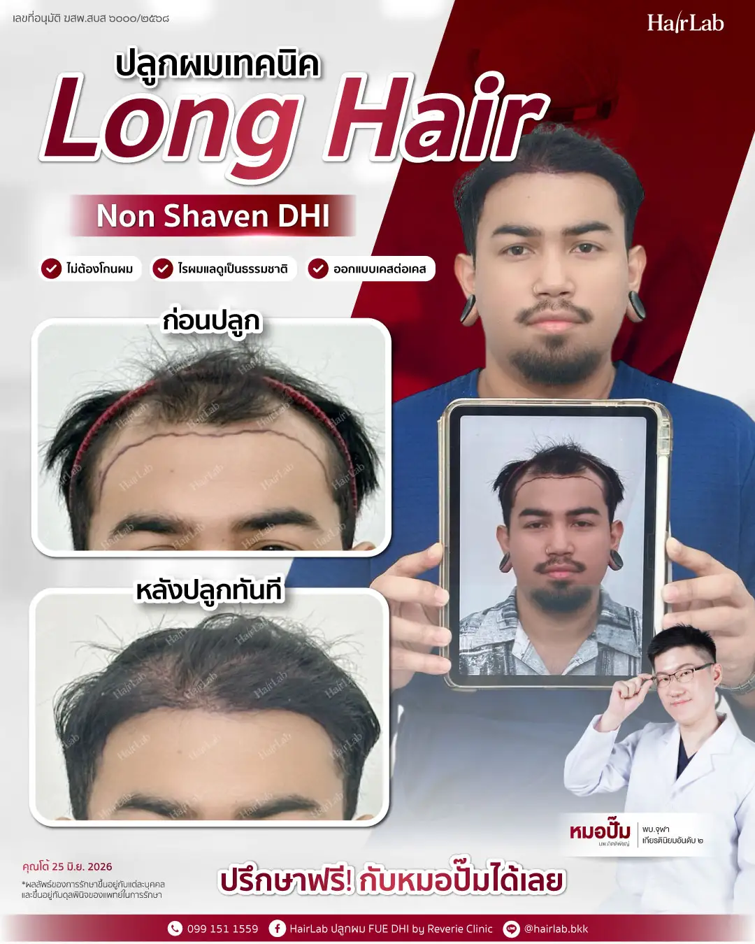 ก่อน-หลังปลูกผมเทคนิค Long Hair-19