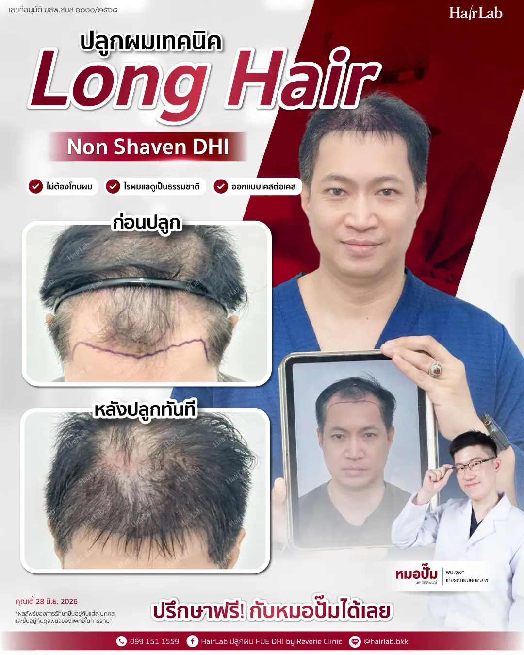 ก่อน-หลังปลูกผมเทคนิค Long Hair-20