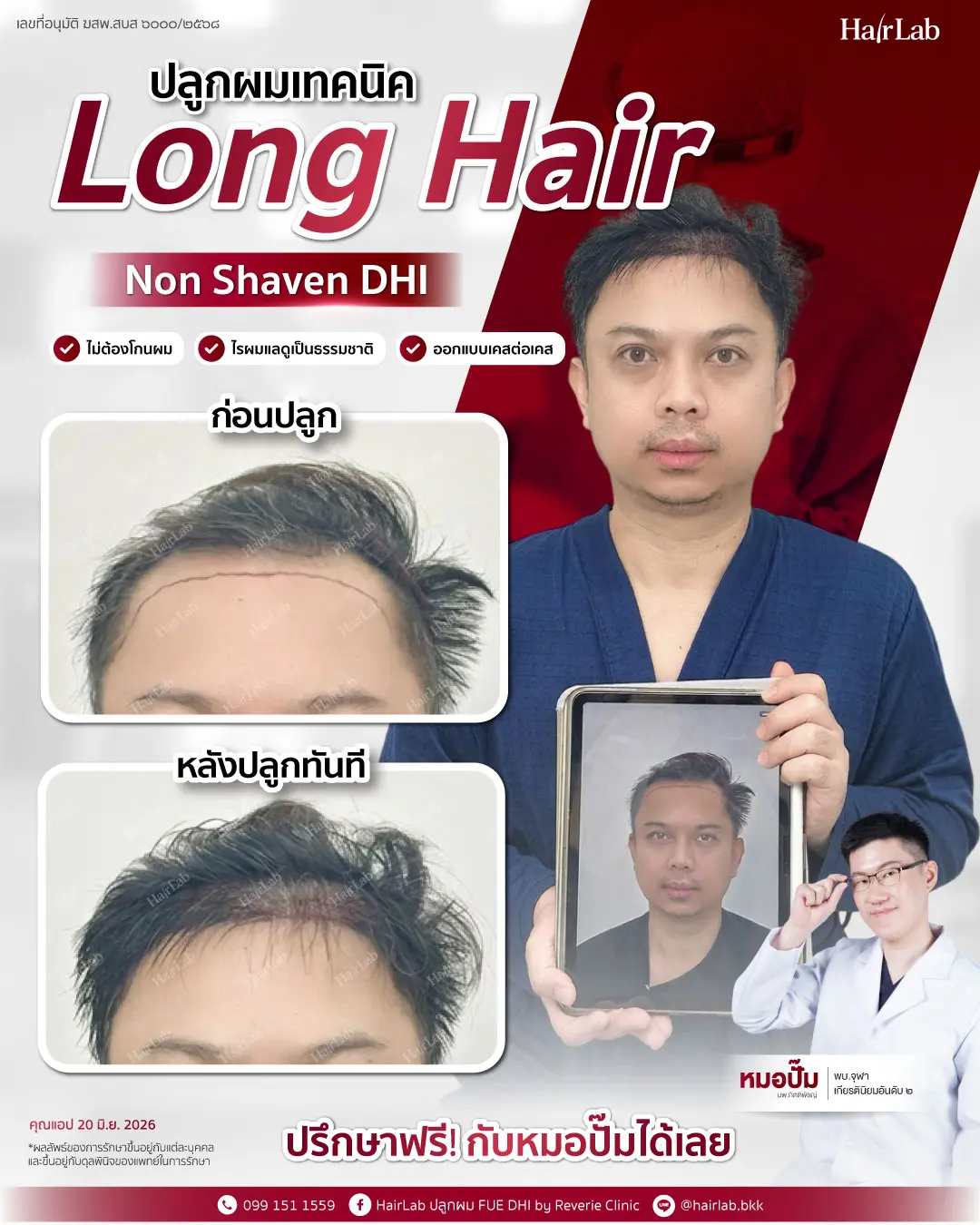 ก่อน-หลังปลูกผมเทคนิค Long Hair-21