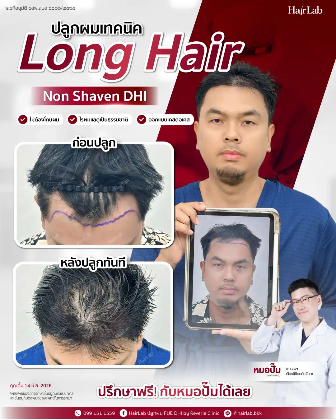 ก่อน-หลังปลูกผมเทคนิค Long Hair-22