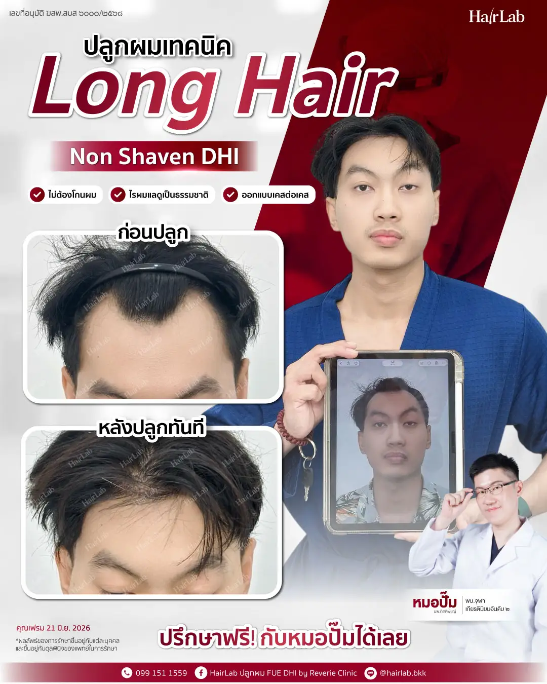 ก่อน-หลังปลูกผมเทคนิค Long Hair-23