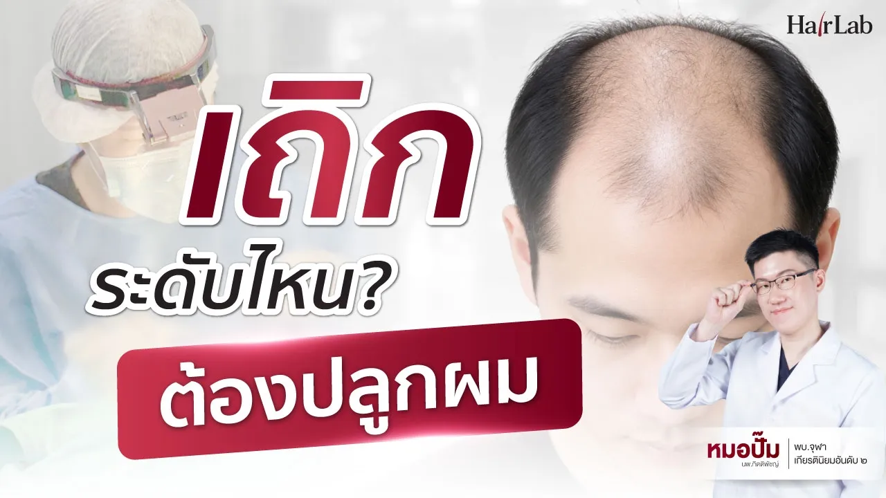 ปกคลิปหัวเถิกระดับไหนต้องปลูกผม