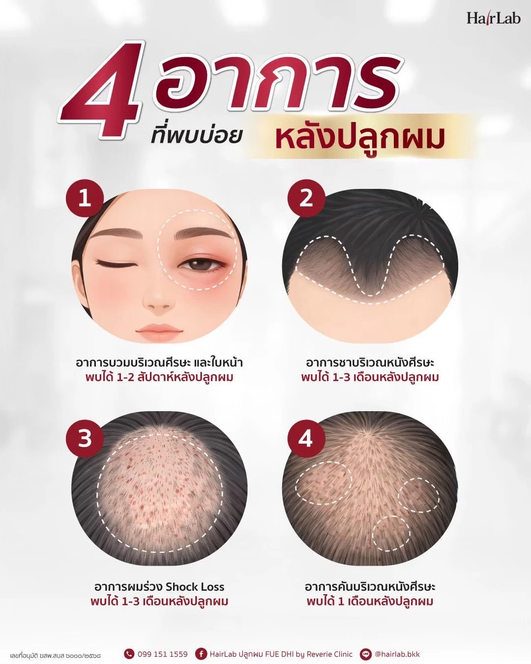 4 อาการที่พบบ่อยหลังปลูกผม