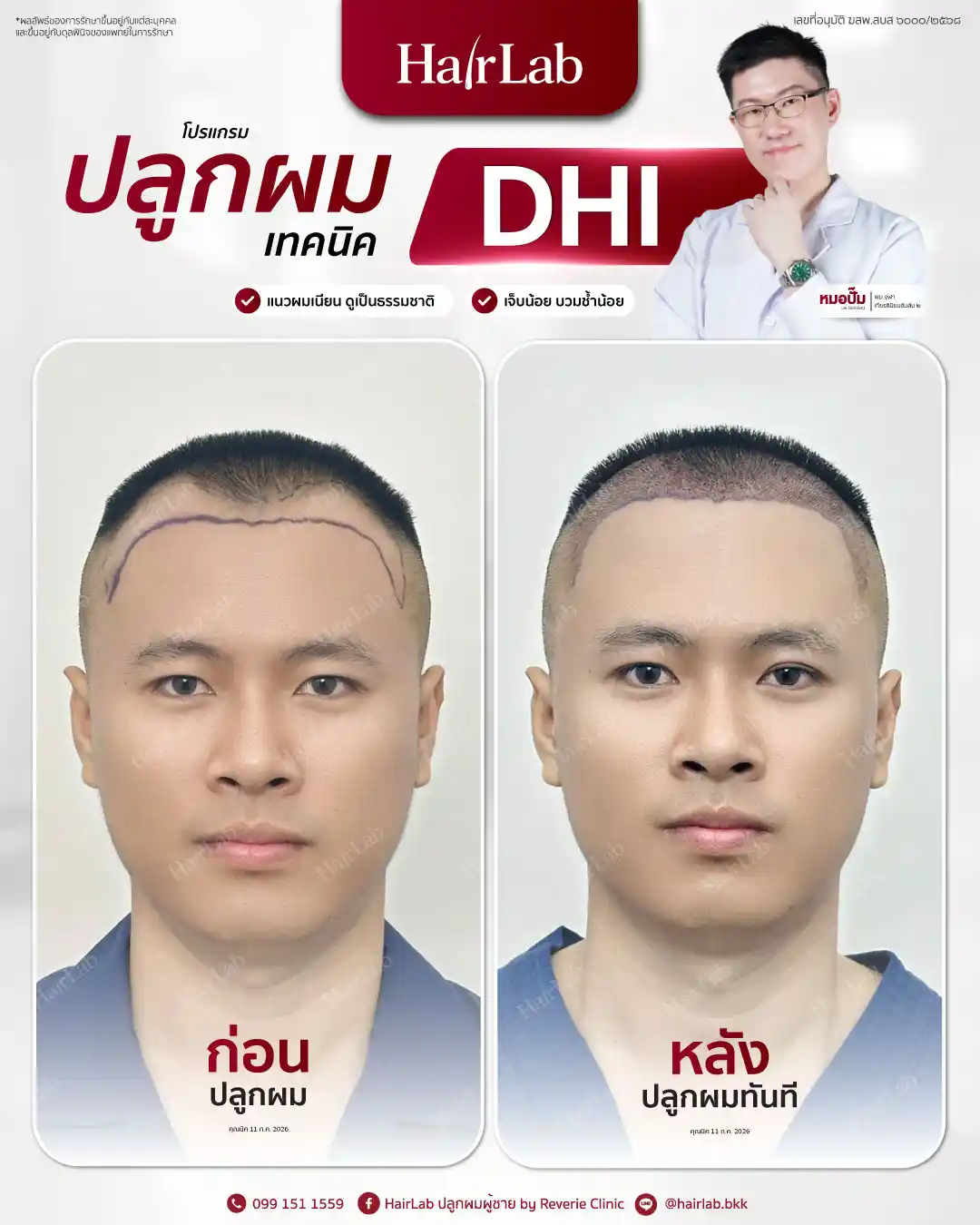 ก่อน-หลังปลูกผมเทคนิค DHI -28