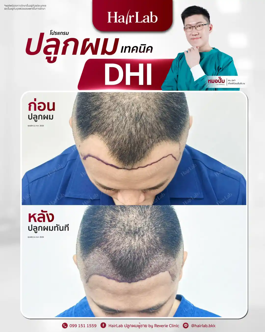 ก่อน-หลังปลูกผมเทคนิค DHI -29