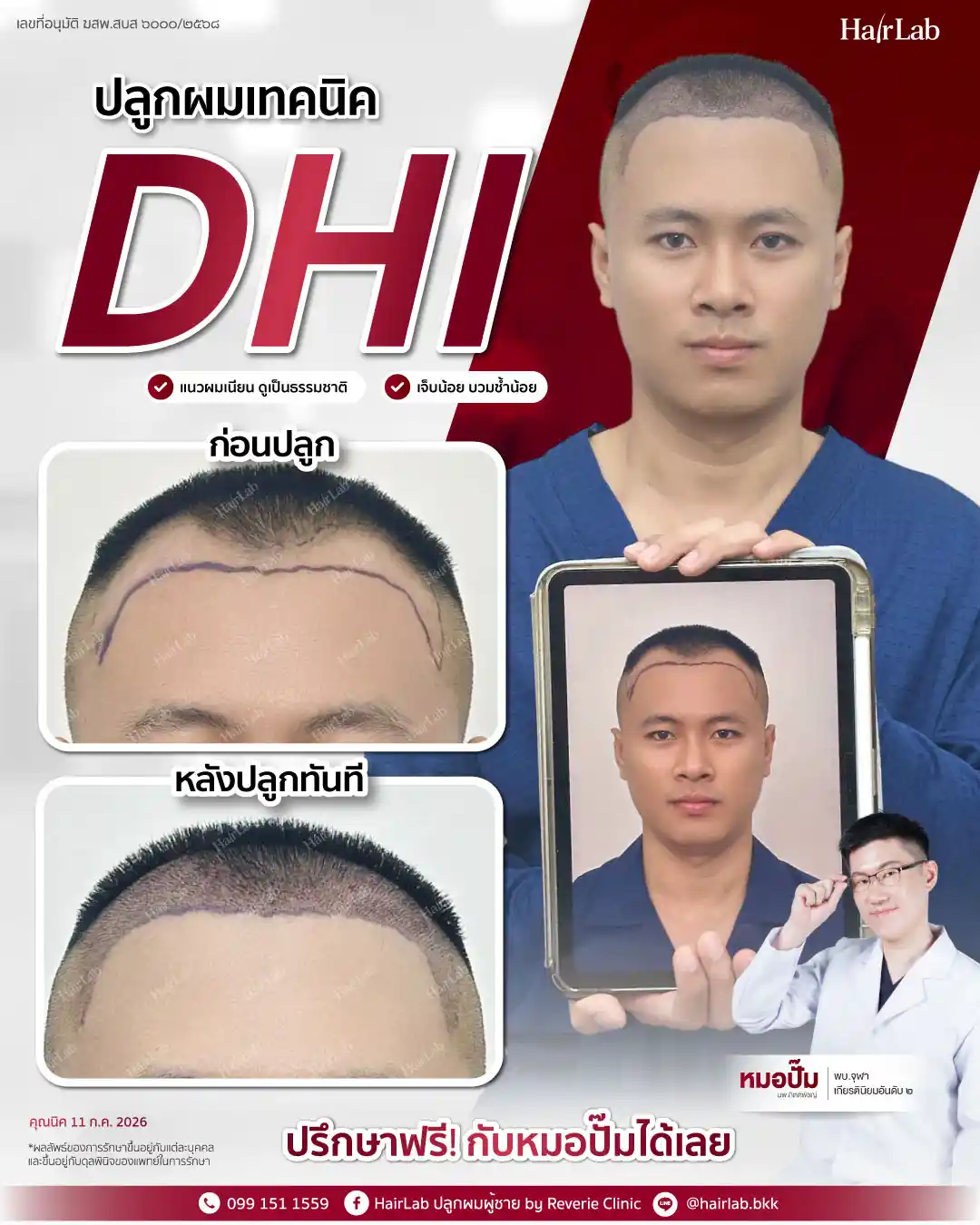 ก่อน-หลังปลูกผมเทคนิค DHI -30