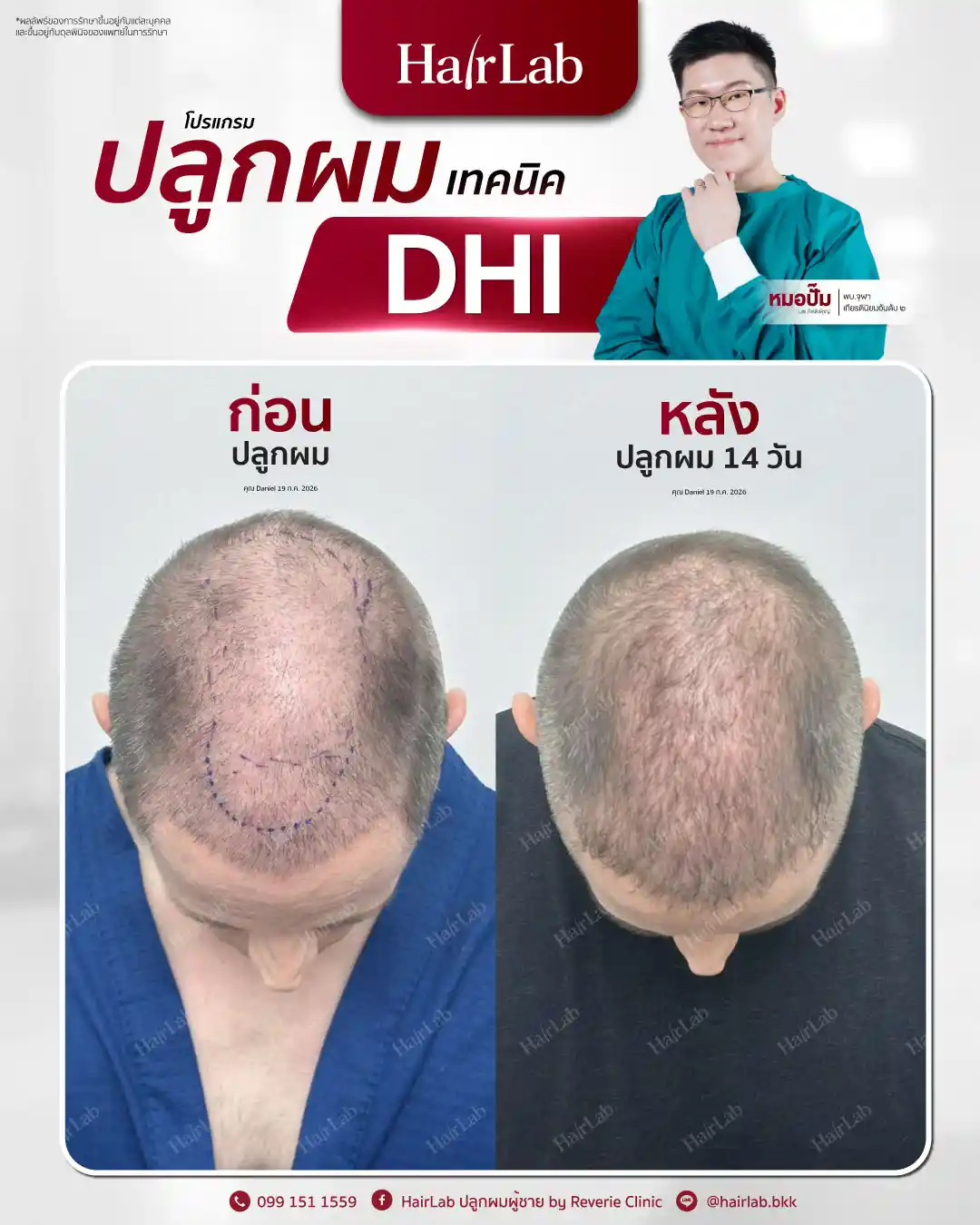 ก่อน-หลังปลูกผมเทคนิค DHI -32