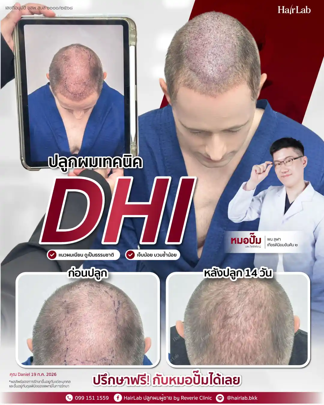 ก่อน-หลังปลูกผมเทคนิค DHI -33