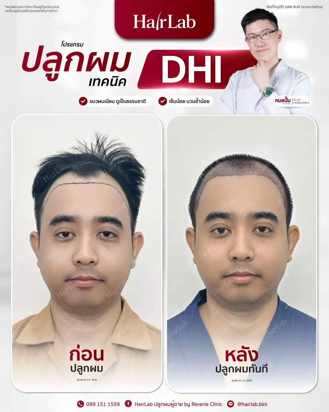 ก่อน-หลังปลูกผมเทคนิค DHI -34