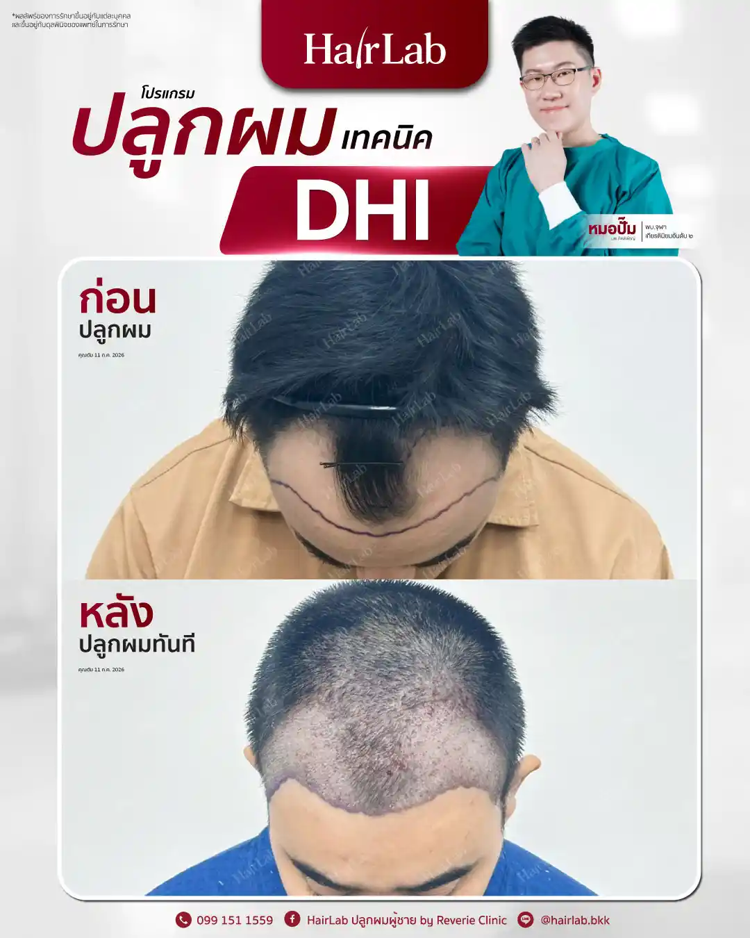 ก่อน-หลังปลูกผมเทคนิค DHI -35