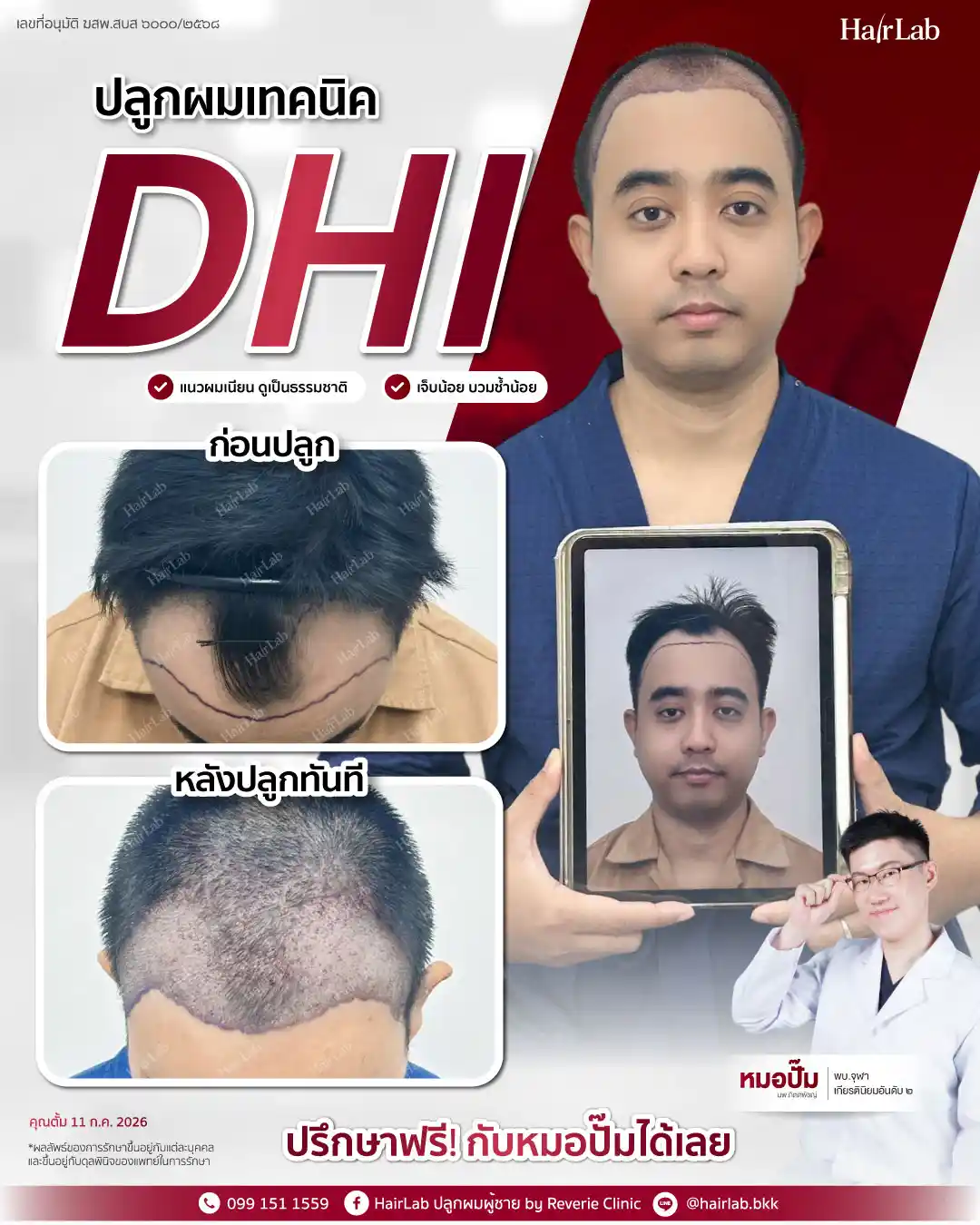 ก่อน-หลังปลูกผมเทคนิค DHI -36