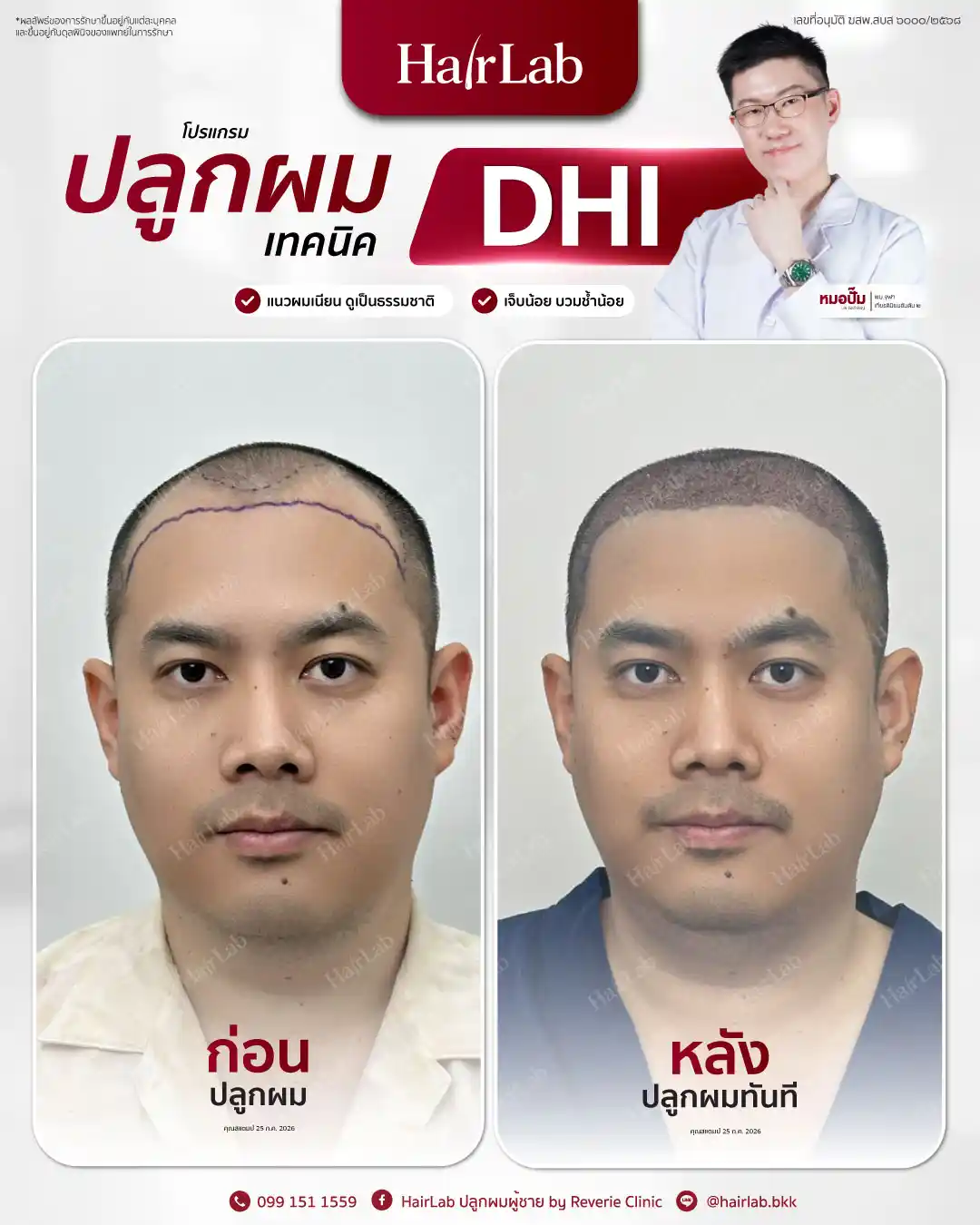 ก่อน-หลังปลูกผมเทคนิค DHI -37