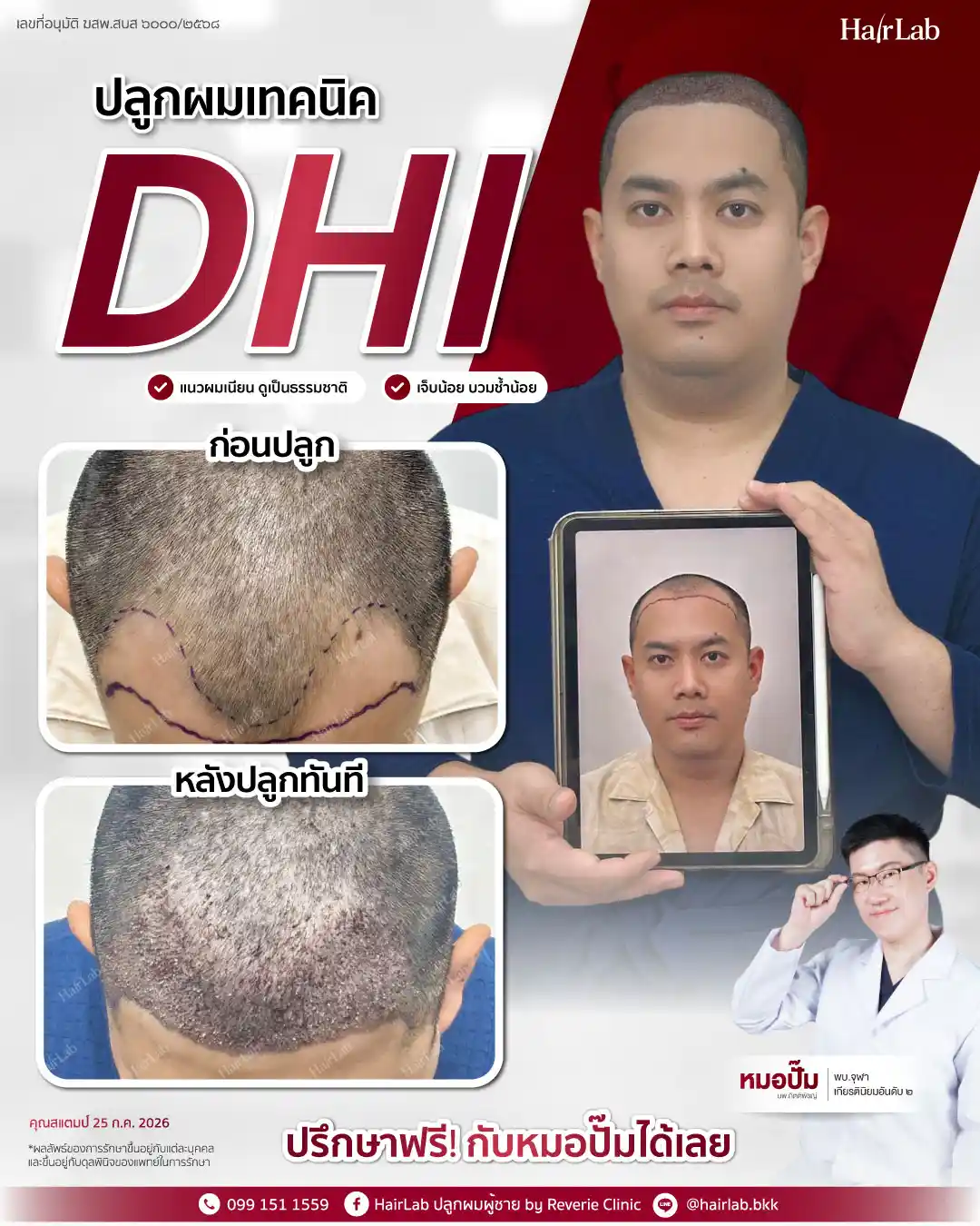 ก่อน-หลังปลูกผมเทคนิค DHI -39