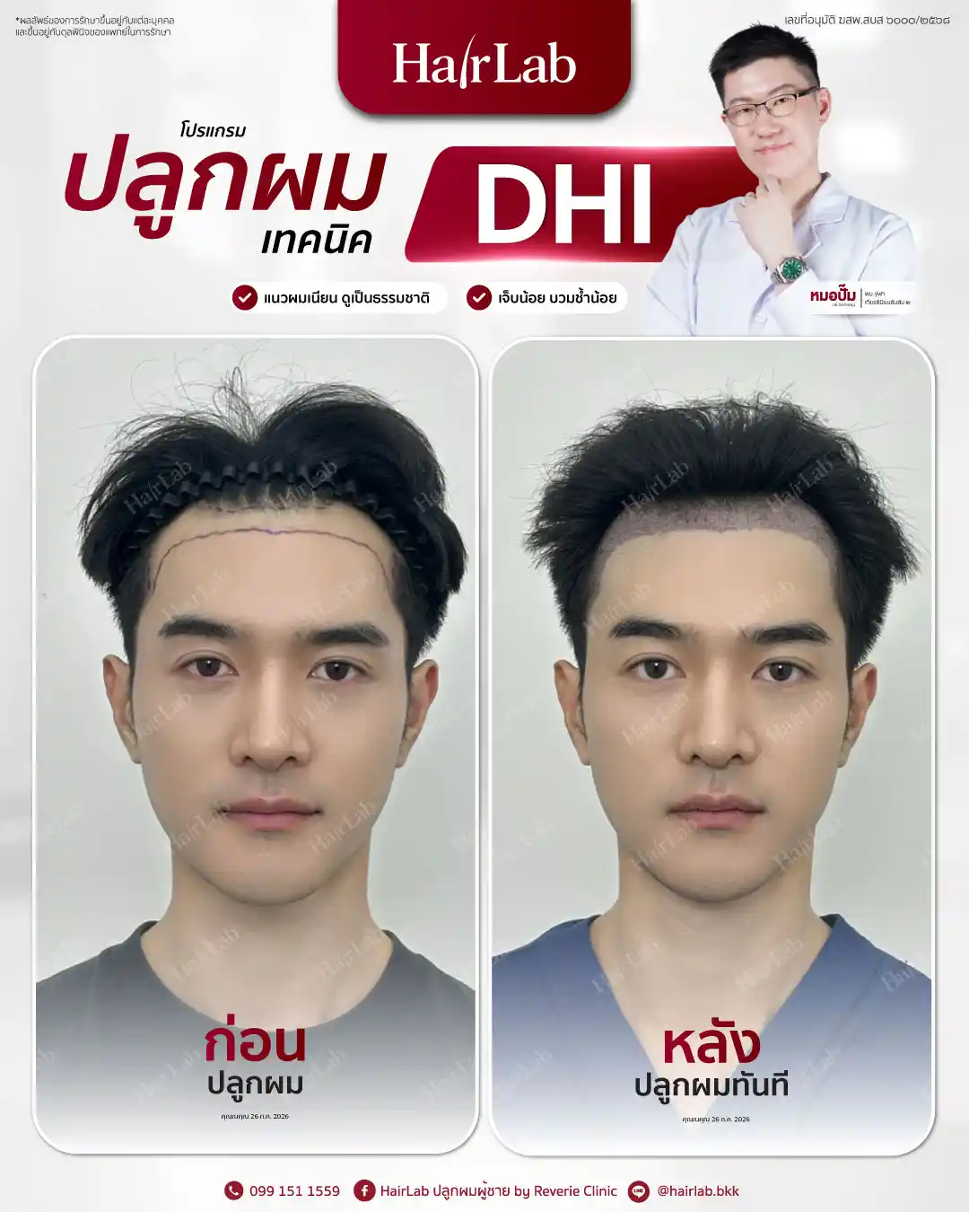 ก่อน-หลังปลูกผมเทคนิค DHI -40