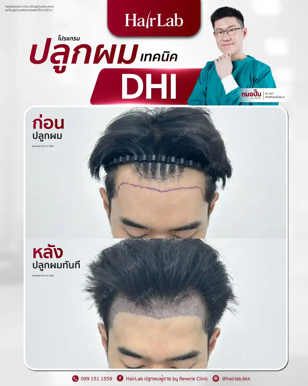 ก่อน-หลังปลูกผมเทคนิค DHI -41