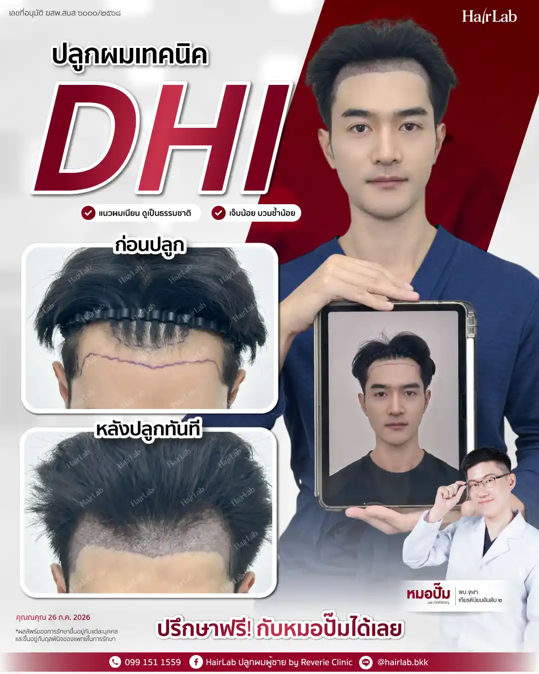 ก่อน-หลังปลูกผมเทคนิค DHI -42