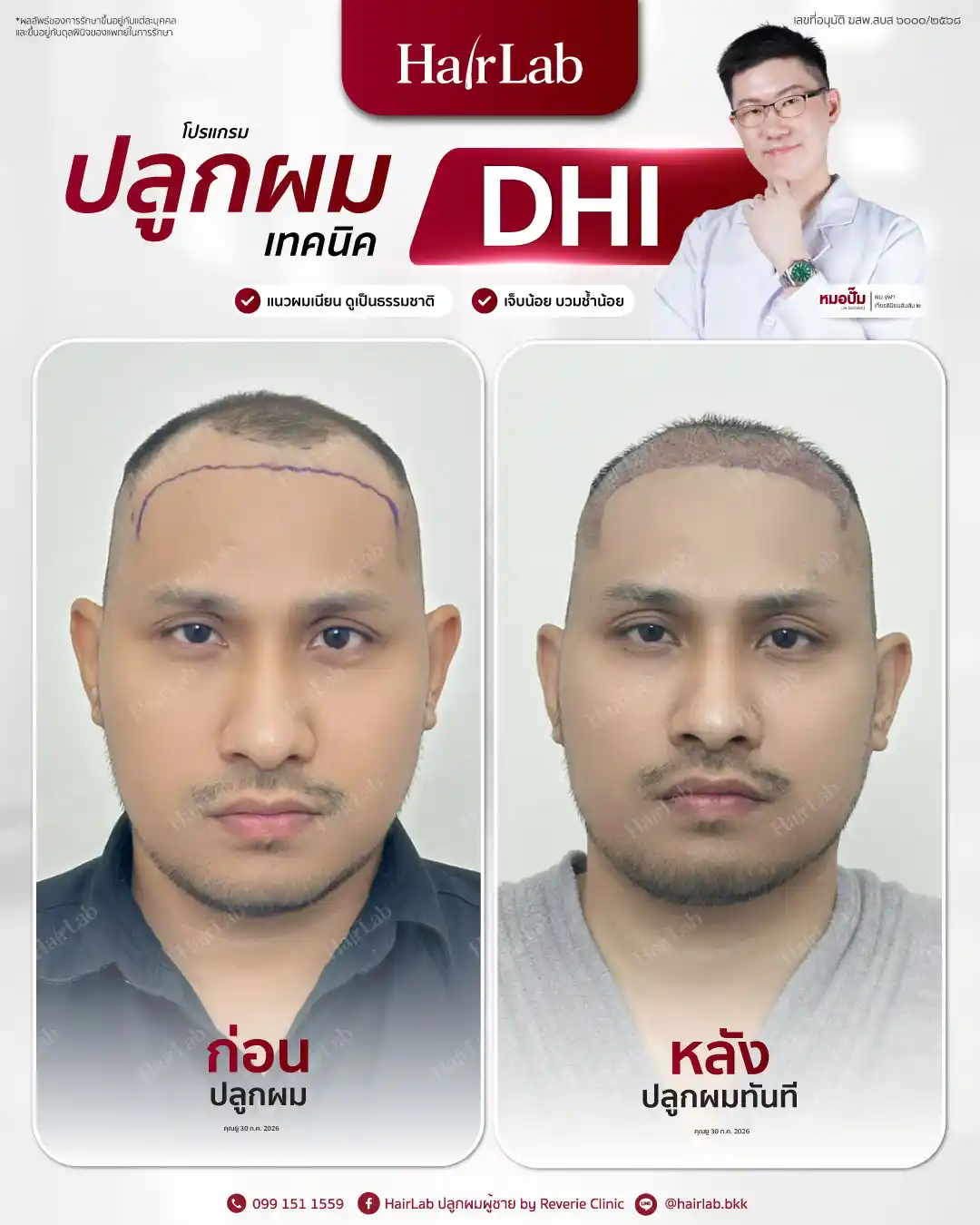 ก่อน-หลังปลูกผมเทคนิค DHI -43