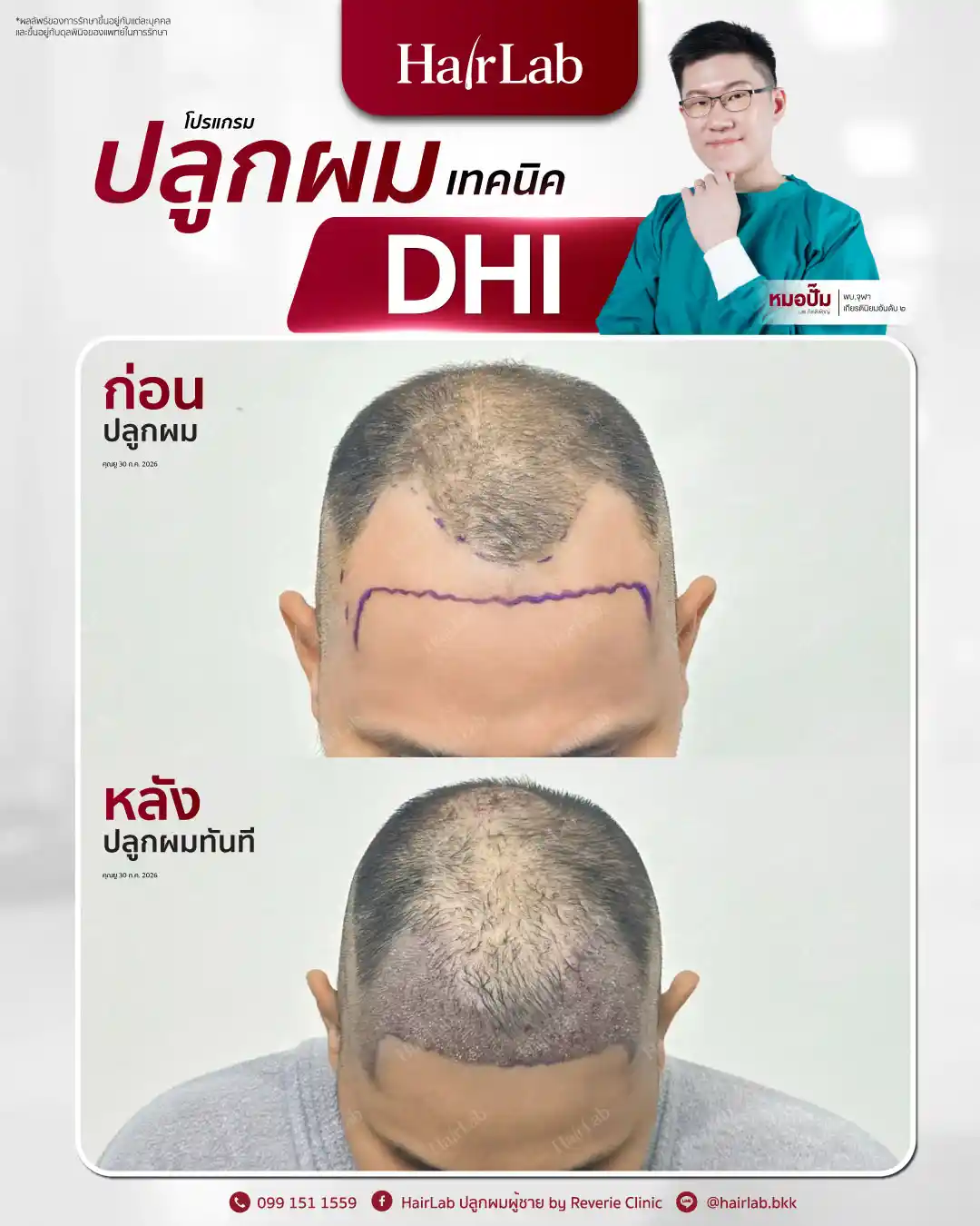 ก่อน-หลังปลูกผมเทคนิค DHI -44