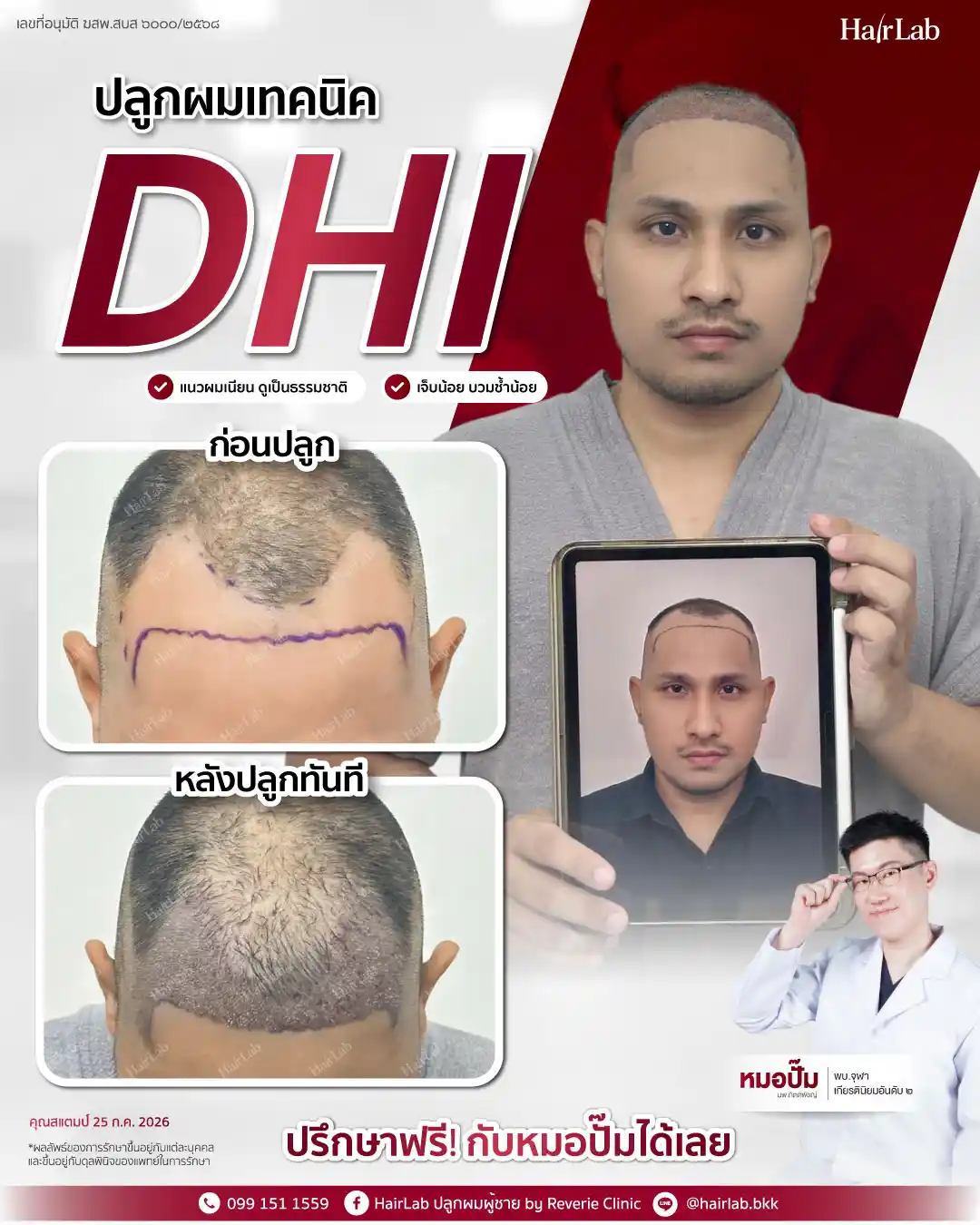 ก่อน-หลังปลูกผมเทคนิค DHI -45