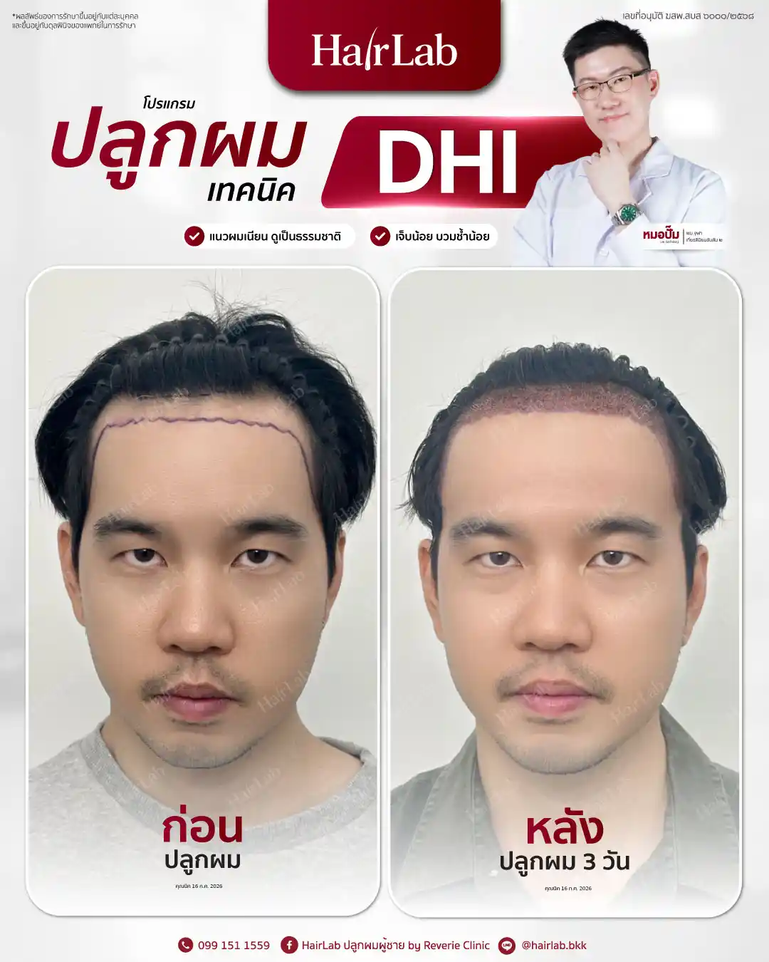 ก่อน-หลังปลูกผมเทคนิค DHI -46