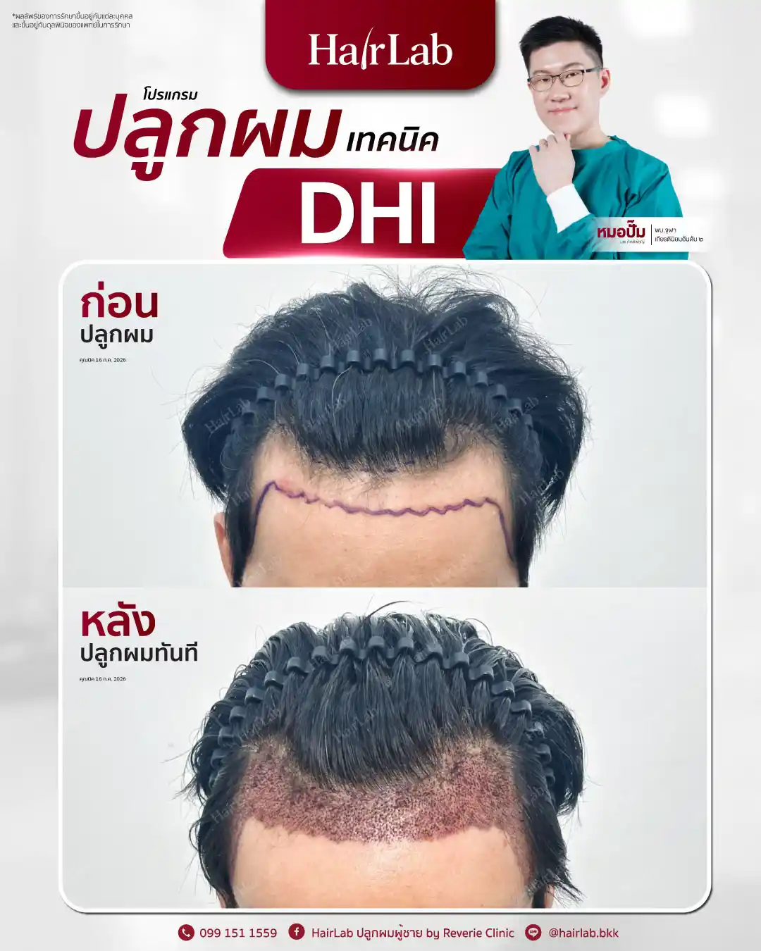 ก่อน-หลังปลูกผมเทคนิค DHI -47