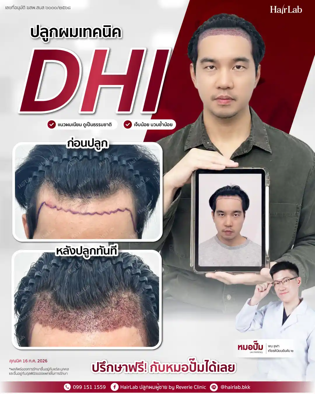 ก่อน-หลังปลูกผมเทคนิค DHI -48