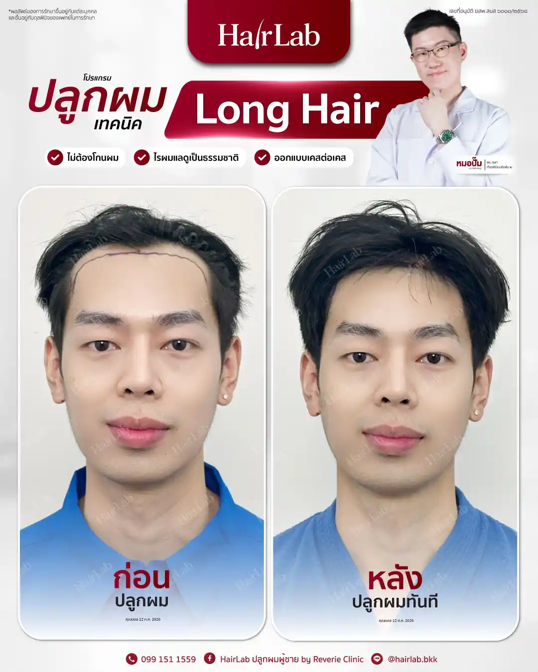ก่อน-หลังปลูกผมเทคนิค Long Hair-24